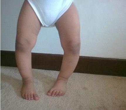 krivy e nozhki u rebenka 2